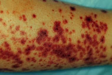 iga vasculitis